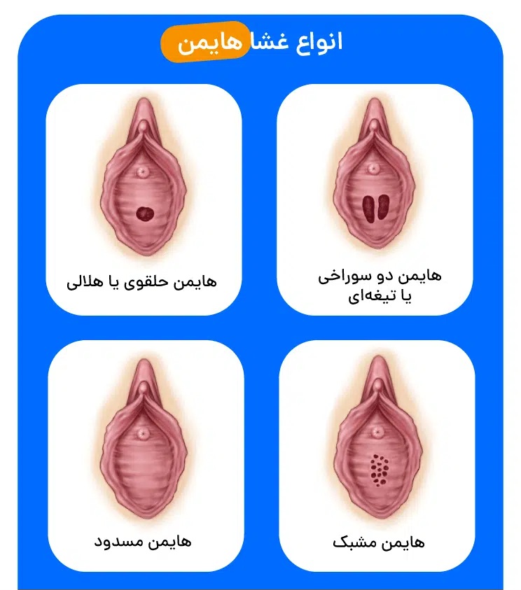 انواع پرده بکارت