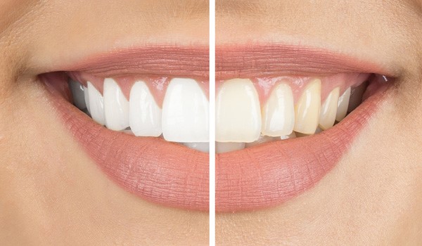 روغنی که دندان ها را سفید می کند+ راهنما