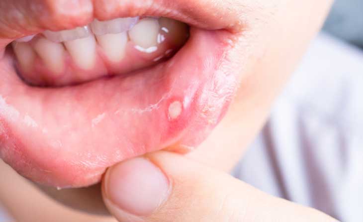برای درمان آفت دهان چه کنیم؟/ علت ایجاد آفت دهان چیست؟