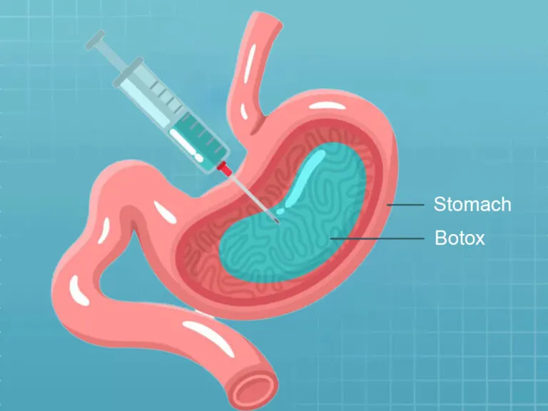 بوتاکس معده چیست و چه عوارض خطرناکی دارد؟