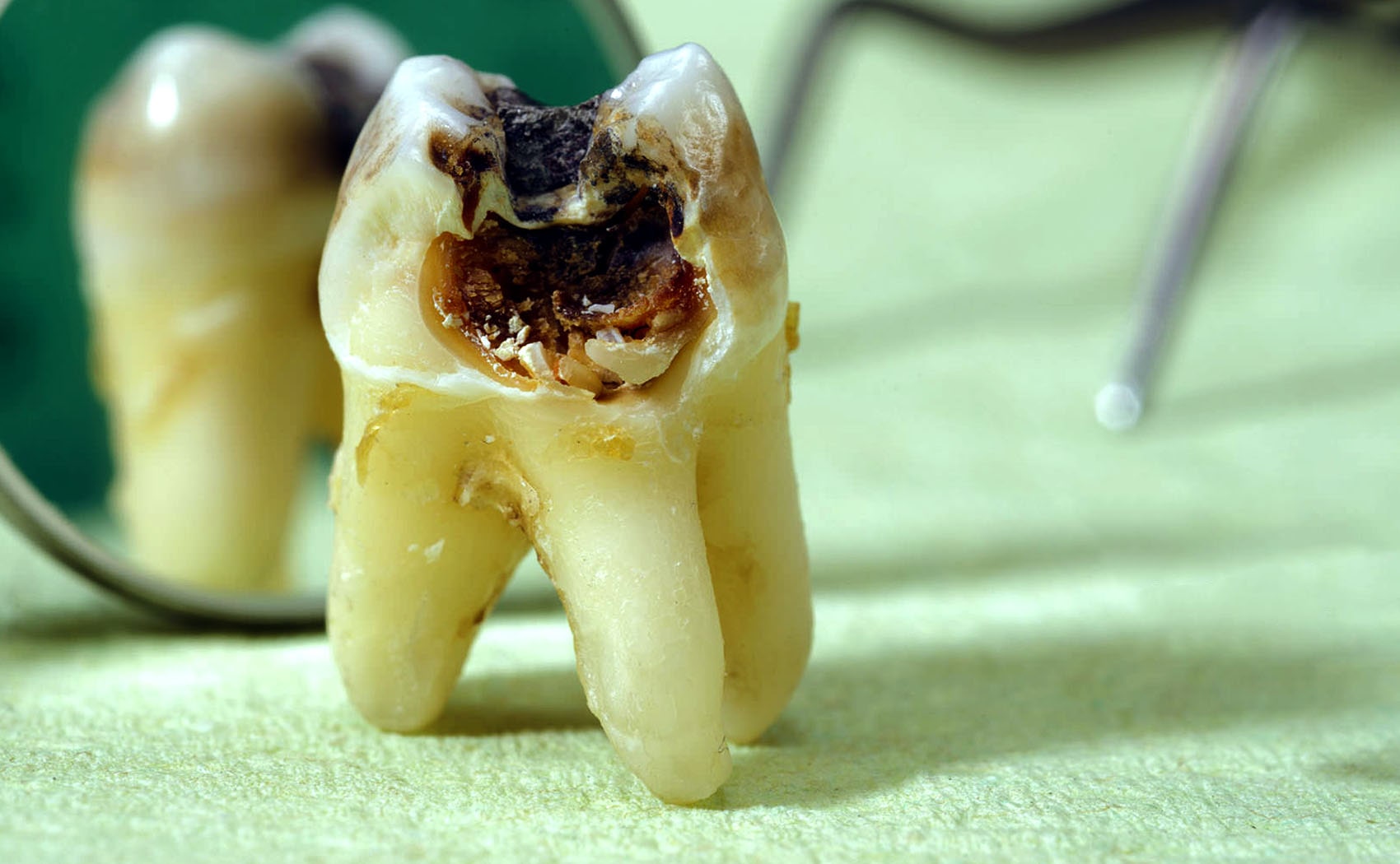 اگر می خواهید دچار پوسیدگی دندان نشوید این مواد غذایی را کمتر مصرف کنید