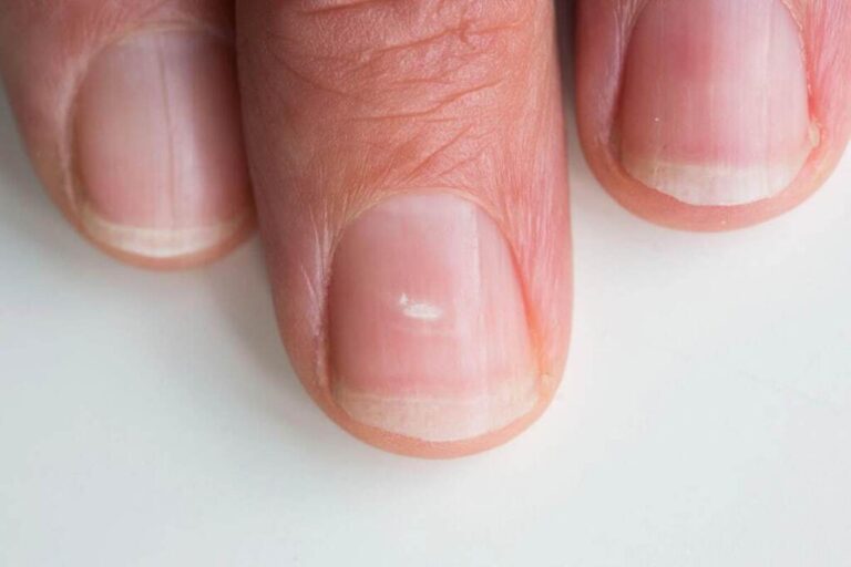 علت ایجاد لکه های سفید روی ناخن چیست؟