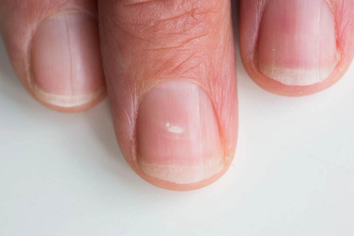 علت ایجاد لکه های سفید روی ناخن چیست؟